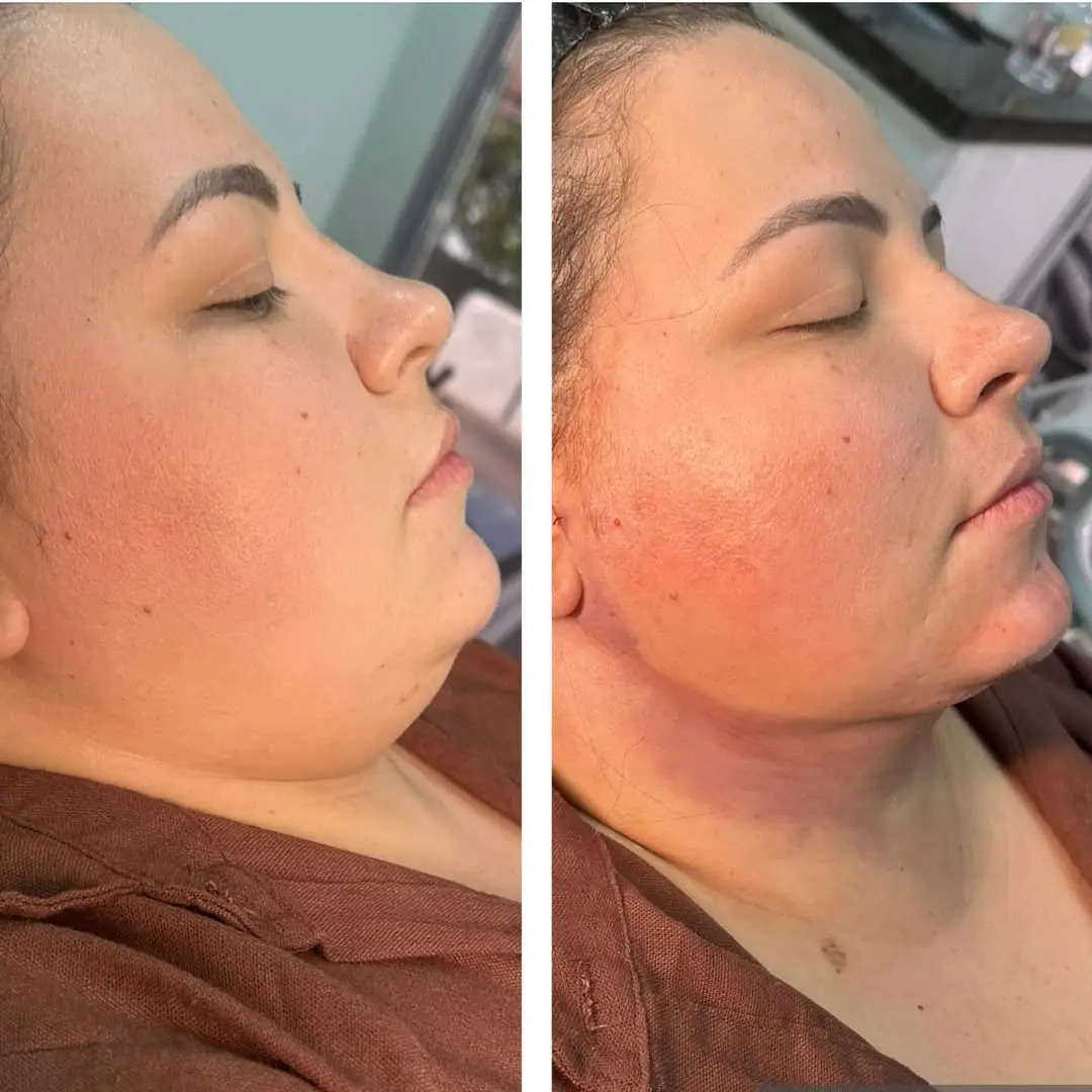 Antes e depois de harmonização orofacial em Goiânia — caso 2, Studio Dental