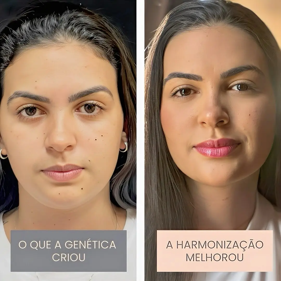 Antes e depois de harmonização orofacial em Goiânia — caso 3, Studio Dental
