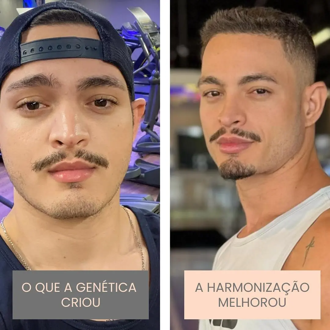 Antes e depois de harmonização orofacial em Goiânia — caso 6, Studio Dental